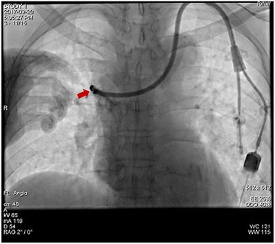 Case Report: Efficiency of Embolization Microcoils for the Repair of Brachiocephalic Vein Perforation During Hemodialysis Catheter Placement